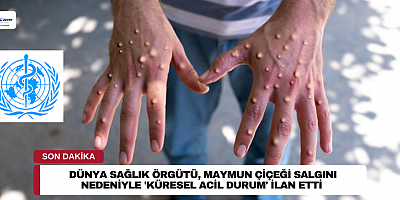  Dünya Sağlık Örgütü, maymun çiçeği salgını nedeniyle 'küresel acil durum' ilan etti