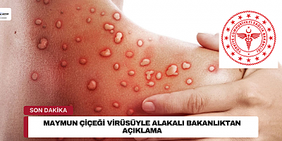Maymun Çiçeği Virüsüyle Alakalı Bakanlıktan Açıklama